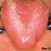 Как проявляется ВИЧ-инфицирование в полости рта — фото язв и налета на языке