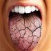 Сухость во рту — причина какой болезни?